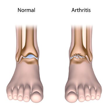 Ankle Arthritis