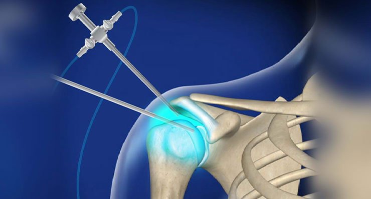 Arthroscopic Surgery