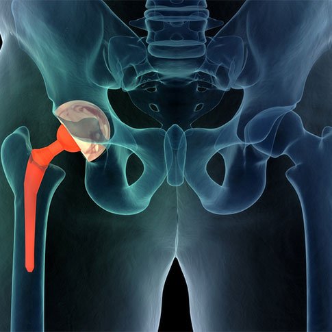 Hip Replacement