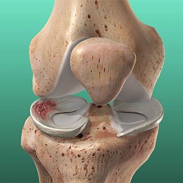 Meniscus Tear