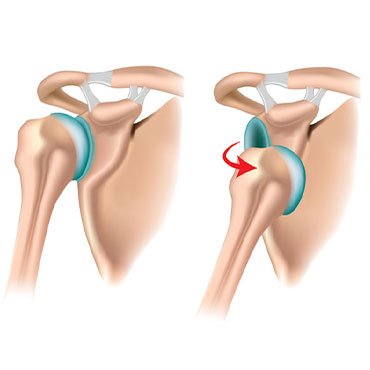 Recurrent Dislocations