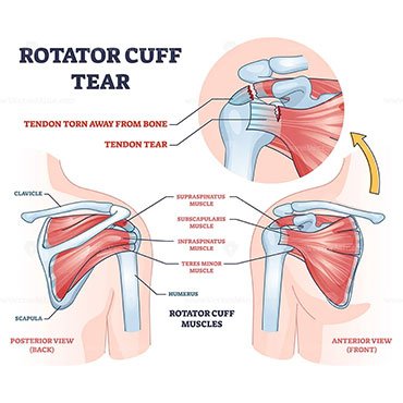 Rotator Cuff Tear