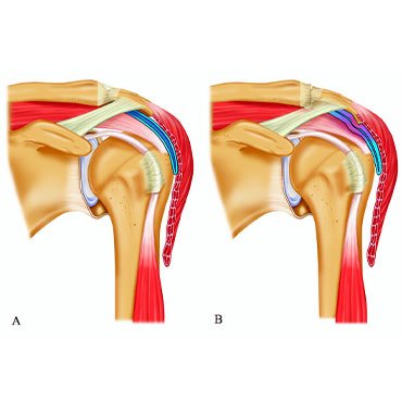 Impingement