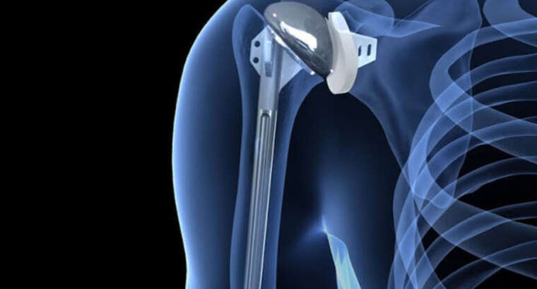 Revolutionizing Mobility: The Art of Shoulder Replacement Surgery