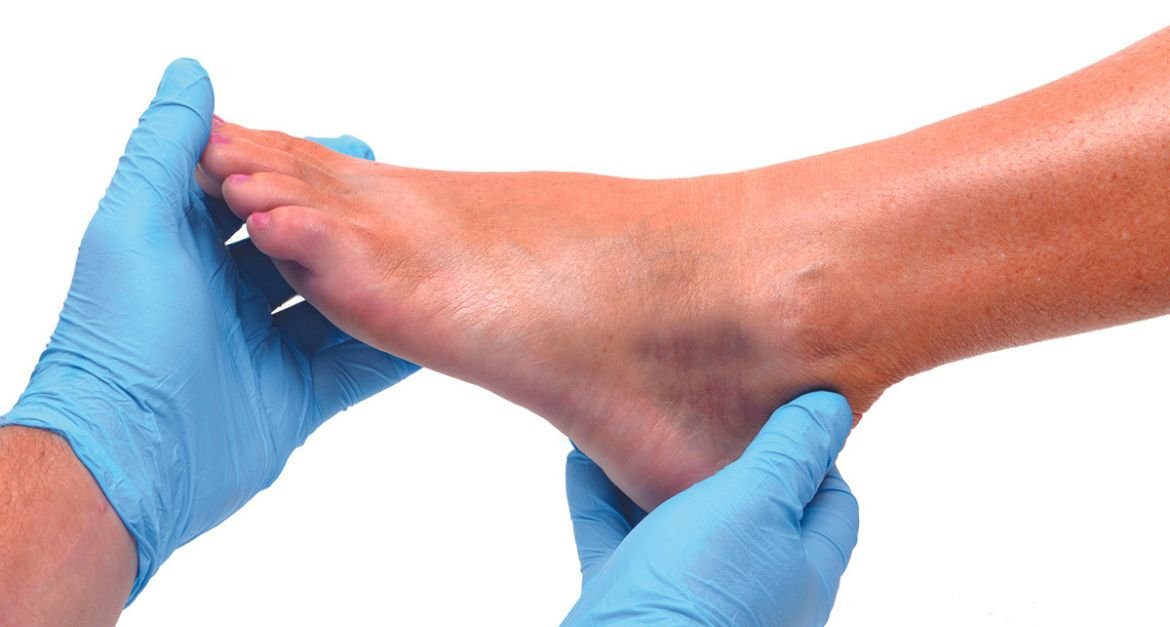 Heel Pain Demystified: Causes, Symptoms, and Effective Solutions