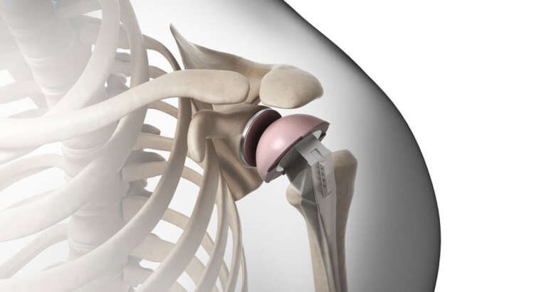 Beyond Limits: How Shoulder Replacement Redefines Possibilities in Motion