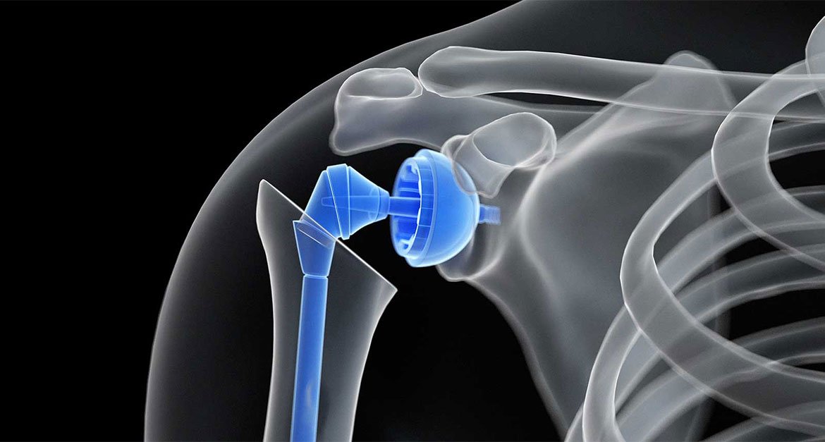 Shoulder Rejuvenation: Exploring the Unique Benefits of Shoulder Replacement Surgery