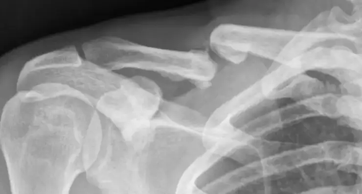 Complex Trauma & Non-Unions