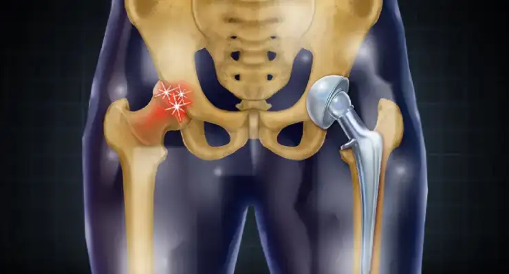 Pelvis Acetabular Trauma and Hip Replacement