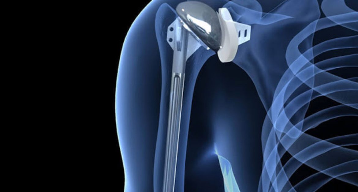 The Art of Shoulder Replacement Surgery