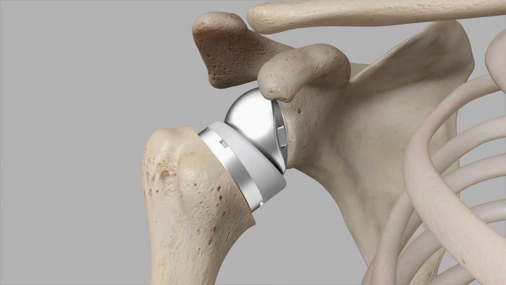 Shoulder Replacement Rehab A Comprehensive Guide to Optimal Recovery