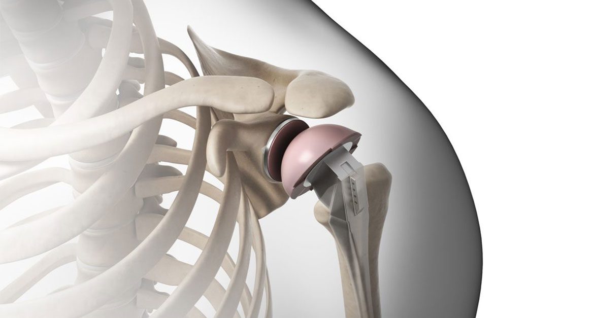 How Shoulder Replacement Redefines Possibilities in Motion
