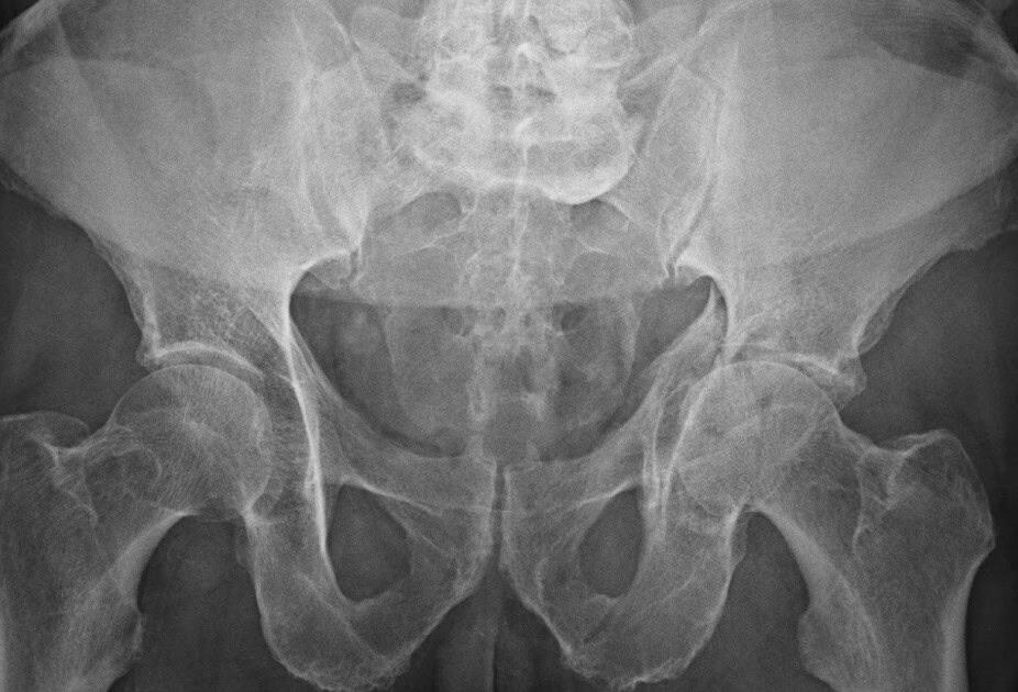 Pelvis & Acetabular Trauma Specialist in Chandigarh