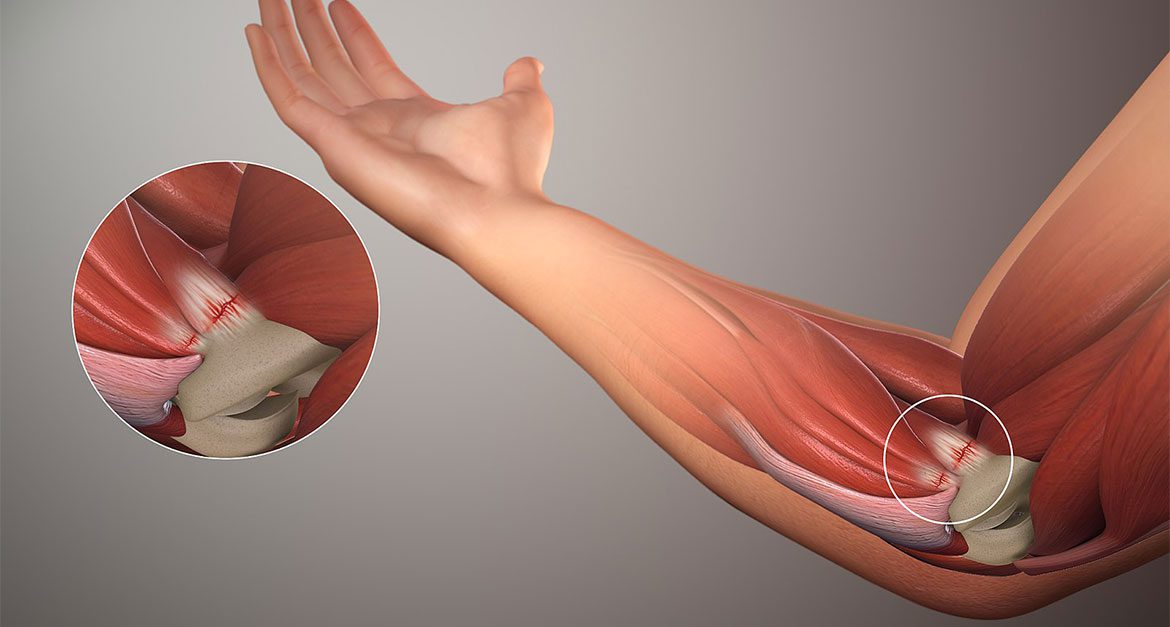 Navigating Life After Elbow Replacement