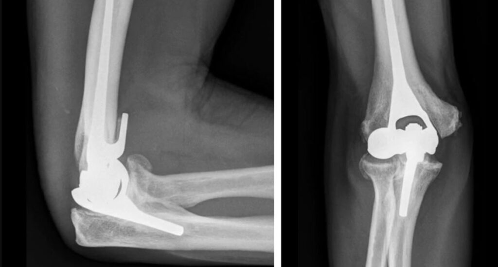 Navigating Elbow Replacement Surgery & Recovery Roadmap