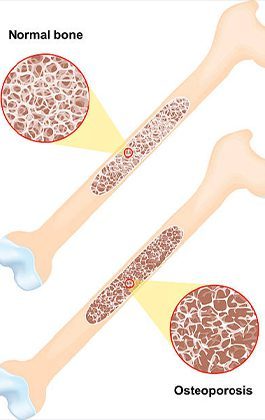 Osteoporosis Management in Chandigarh Dr Ritesh Khokhar