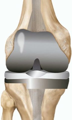 Joint Replacement Surgeon in Chandigarh Dr Ritesh Khokhar